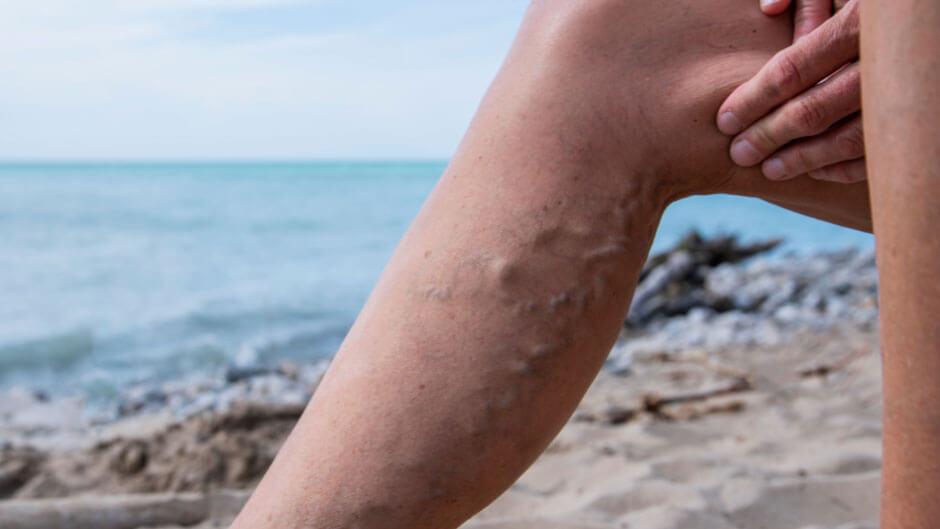 Understanding Varicose Veins: Causes, Symptoms, and Treatment Options