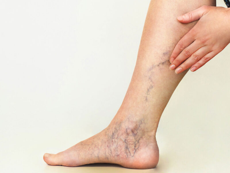 Summer Tips to Help Manage Chronic Venous Insufficiency